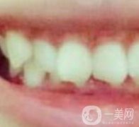 張家港澳洋醫(yī)院整牙怎么樣？牙齒矯正價格及經(jīng)歷分享