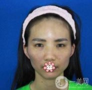 上海第九人民醫(yī)院整形外科價格表，附面部脂肪填充案例