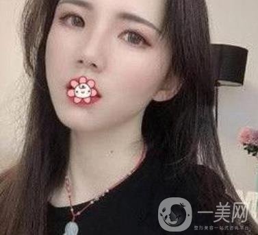 上海第九人民醫(yī)院整形外科價(jià)格表，附面部脂肪填充案例