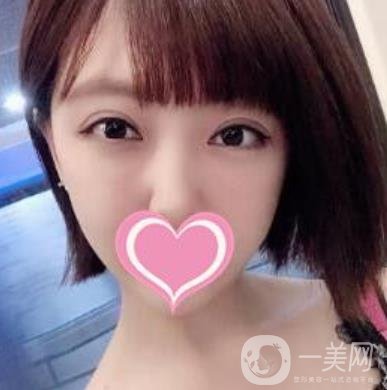 上海第一醫(yī)院整形外科價格表明細(xì)及割雙眼皮日記分享