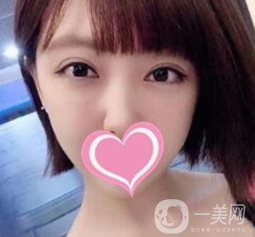 上海第一醫(yī)院整形外科價格表明細(xì)及割雙眼皮日記分享