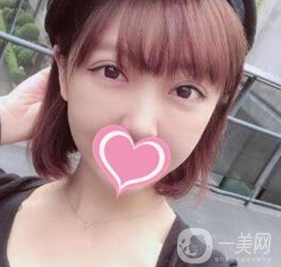 上海第一醫(yī)院整形外科價格表明細(xì)及割雙眼皮日記分享
