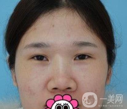 2020北京大學深圳醫(yī)院整形科價格表，附雙眼皮案例