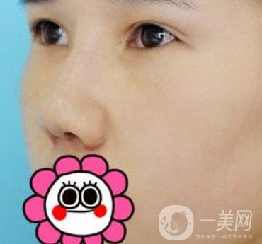 2020北京大學深圳醫(yī)院整形科價格表，附雙眼皮案例