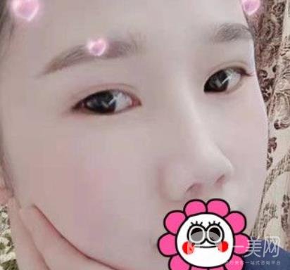 2020北京大學深圳醫(yī)院整形科價格表，附雙眼皮案例