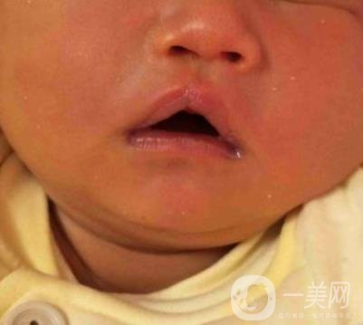 昆明醫(yī)科大學(xué)第一附屬醫(yī)院整形科價(jià)格表，內(nèi)附兔唇矯正案例