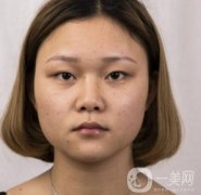 西安市中心醫(yī)院整形科價格表，內(nèi)附韓悅雙眼皮真人案例