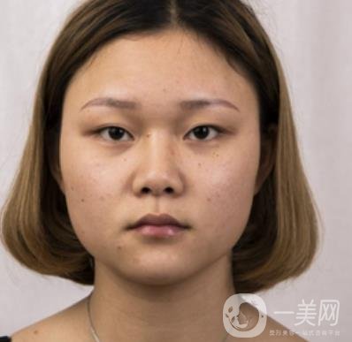 西安市中心醫(yī)院整形科價(jià)格表，內(nèi)附韓悅雙眼皮真人案例
