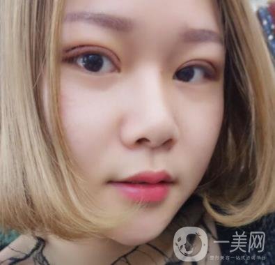 西安市中心醫(yī)院整形科價(jià)格表，內(nèi)附韓悅雙眼皮真人案例