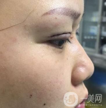 西安市中心醫(yī)院整形科價(jià)格表，內(nèi)附韓悅雙眼皮真人案例