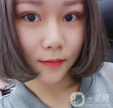 西安市中心醫(yī)院整形科價(jià)格表，內(nèi)附韓悅雙眼皮真人案例