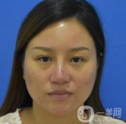 張掖市人民醫(yī)院美容整形科價格表，附眼袋切除果圖