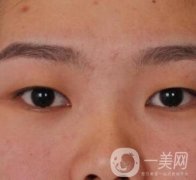 北京醫(yī)院整形項目2020年價格表一覽，內(nèi)附錢文江開眼角案例