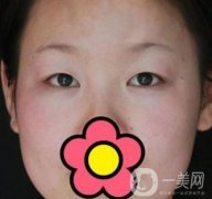 甘肅省人民醫(yī)院割雙眼皮怎么樣？附整形價(jià)格表及真人案例