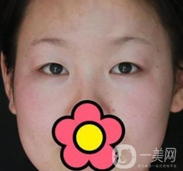 甘肅省人民醫(yī)院割雙眼皮怎么樣？附整形價格表及真人案例