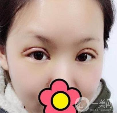 甘肅省人民醫(yī)院割雙眼皮怎么樣？附整形價格表及真人案例