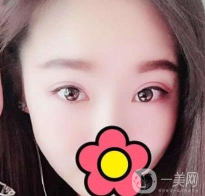 甘肅省人民醫(yī)院割雙眼皮怎么樣？附整形價格表及真人案例