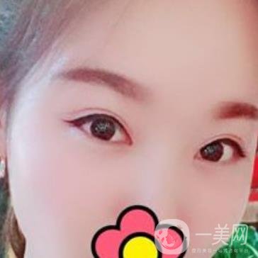 甘肅省人民醫(yī)院割雙眼皮怎么樣？附整形價格表及真人案例