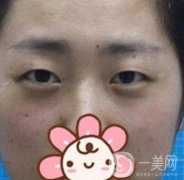 秦皇島人民醫(yī)院雙眼皮怎么樣？附整形價(jià)格表及案例圖