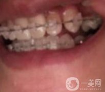 蘭山區(qū)人民醫(yī)院整牙多少錢？牙齒矯正案例分享