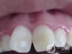 泉州人民醫(yī)院整牙多少錢？牙齒矯正恢復(fù)情況介紹