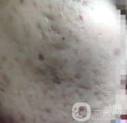 綿陽(yáng)中心醫(yī)院整形美容科祛痘坑怎么樣？?jī)r(jià)格表及術(shù)后果分享