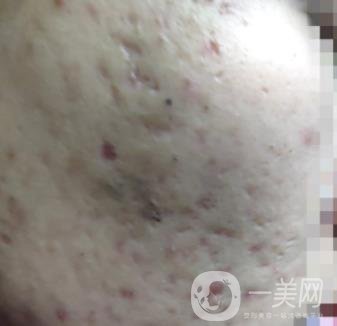 綿陽中心醫(yī)院整形美容科祛痘坑怎么樣？價格表及術(shù)后*果分享