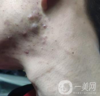 綿陽中心醫(yī)院整形美容科祛痘坑怎么樣？價格表及術(shù)后*果分享
