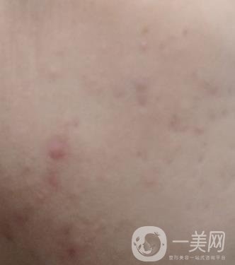 綿陽中心醫(yī)院整形美容科祛痘坑怎么樣？價格表及術(shù)后*果分享