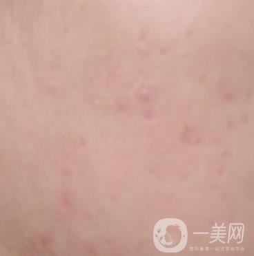 綿陽中心醫(yī)院整形美容科祛痘坑怎么樣？價格表及術(shù)后*果分享