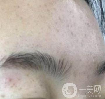 南京省中醫(yī)院整形美容科祛黃褐斑多少錢？價格表及案例詳情一覽