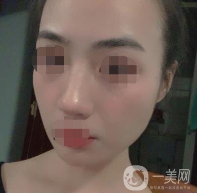 南京省中醫(yī)院整形美容科祛黃褐斑多少錢？價格表及案例詳情一覽
