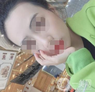 南京省中醫(yī)院整形美容科祛黃褐斑多少錢？價格表及案例詳情一覽