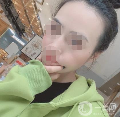 南京省中醫(yī)院整形美容科祛黃褐斑多少錢？價格表及案例詳情一覽