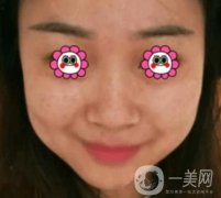岳陽(yáng)市第一人民醫(yī)院整形美容科祛斑好嗎？?jī)r(jià)格表和案例日記分享