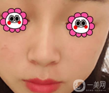 岳陽(yáng)市第一人民醫(yī)院整形美容科祛斑好嗎？?jī)r(jià)格表和案例日記分享
