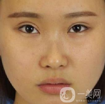河北省中醫(yī)院整形美容科隆鼻怎么樣？?jī)r(jià)格表及術(shù)后恢復(fù)日記分享