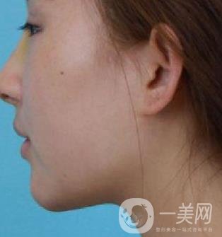 河北省中醫(yī)院整形美容科隆鼻怎么樣？?jī)r(jià)格表及術(shù)后恢復(fù)日記分享