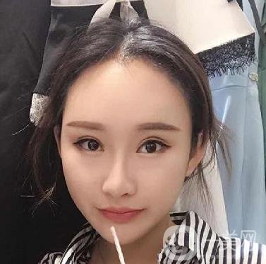 河北省中醫(yī)院整形美容科隆鼻怎么樣？?jī)r(jià)格表及術(shù)后恢復(fù)日記分享