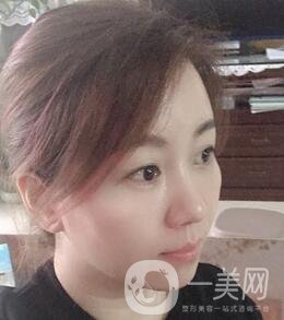 贛州市人民醫(yī)院整形科價格表，附祛眼袋案例分享