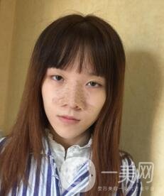 南昌二附院整形科價格表2020，附肋軟骨隆鼻整形案例