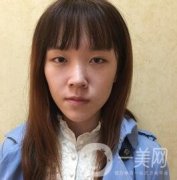 南昌二附院整形科價(jià)格表2020，附肋軟骨隆鼻整形案例