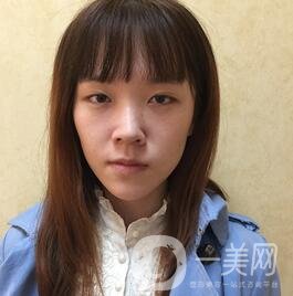 南昌二附院整形科價格表2020，附肋軟骨隆鼻整形案例