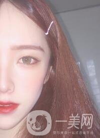 南昌二附院整形科價格表2020，附肋軟骨隆鼻整形案例