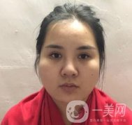 景德鎮(zhèn)第一人民醫(yī)院整形科價(jià)格表，附面部吸脂瘦臉案例