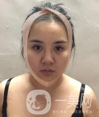 景德鎮(zhèn)第一人民醫(yī)院整形科價格表，附面部吸脂瘦臉案例