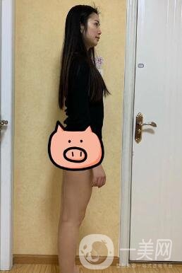 福建省立醫(yī)院整形科價(jià)格(目)表2020，附大小腿吸脂案例