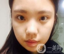 西安唐都醫(yī)院價格表價目表，內(nèi)附吳瓊隆鼻整形日記