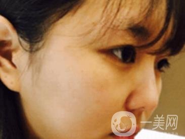 廣州博仕整形醫(yī)院做鼻子多少錢?價格表和整形恢復日記一覽