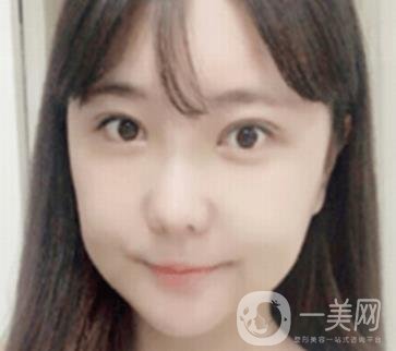 廣州博仕整形醫(yī)院做鼻子多少錢?價格表和整形恢復日記一覽